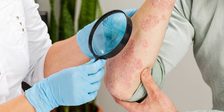 Un tratamiento temprano impacta en la evolución de la psoriasis y previene daños articulares a largo plazo