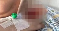 Scottish woman left with 'knife wound' scar after dental procedure left her in 'unbearable pain'