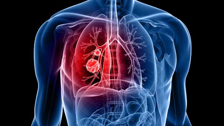 'Zepzelca' el nuevo fármaco español aprobado por EEUU para tratar el cáncer de pulmón