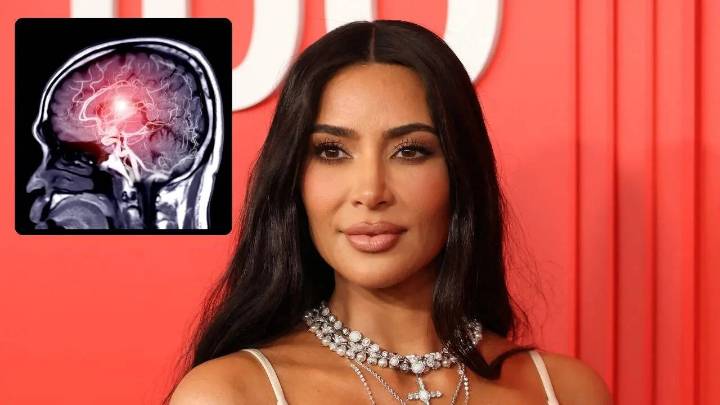Kim Kardashian Hints at Brain Aneurysm After Stressful Divorce; What Is It and How Serious Is It?