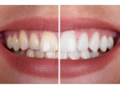 Hints from Heloise: Bleaching you teeth and more ...
