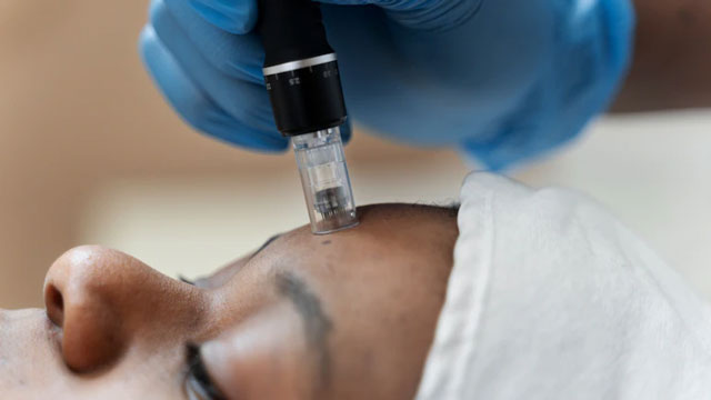FDA warns on microneedling risks amid soaring popularity in India