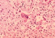 New map tracks measles exposures across Washington