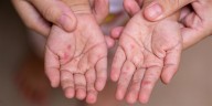 Brote de enfermedad manos, pies y boca contagia a niños en Guatemala