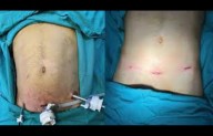 Routine Abdominal Drain Not Recommended After Laparoscopic Appendectomy for Perforated Appendicitis:...
