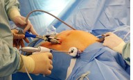 Bariatric Surgery Boosts Cholesterol Efflux, Potentially Reducing ASCVD Risk: Study