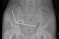 Boy, 13, Has Part of Bowels Removed After Swallowing Up to 100 Magnets Allegedly Purchased on Temu