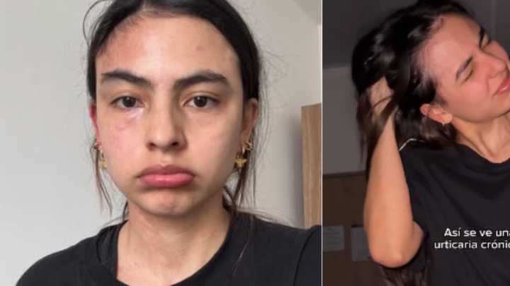 Michell Orozco, actriz de ‘Lady, la vendedora de rosas’, lleva tres meses sin poder dormir por una crisis de urticaria crónica: ‘Ha sido horrible’