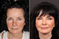 Woman, 65, Gets Plastic Surgery to Address 'Turkey Neck' — Before