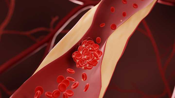Drugs That Lower Cholesterol May Also Reduce Dementia Risk, Says Huge New Study