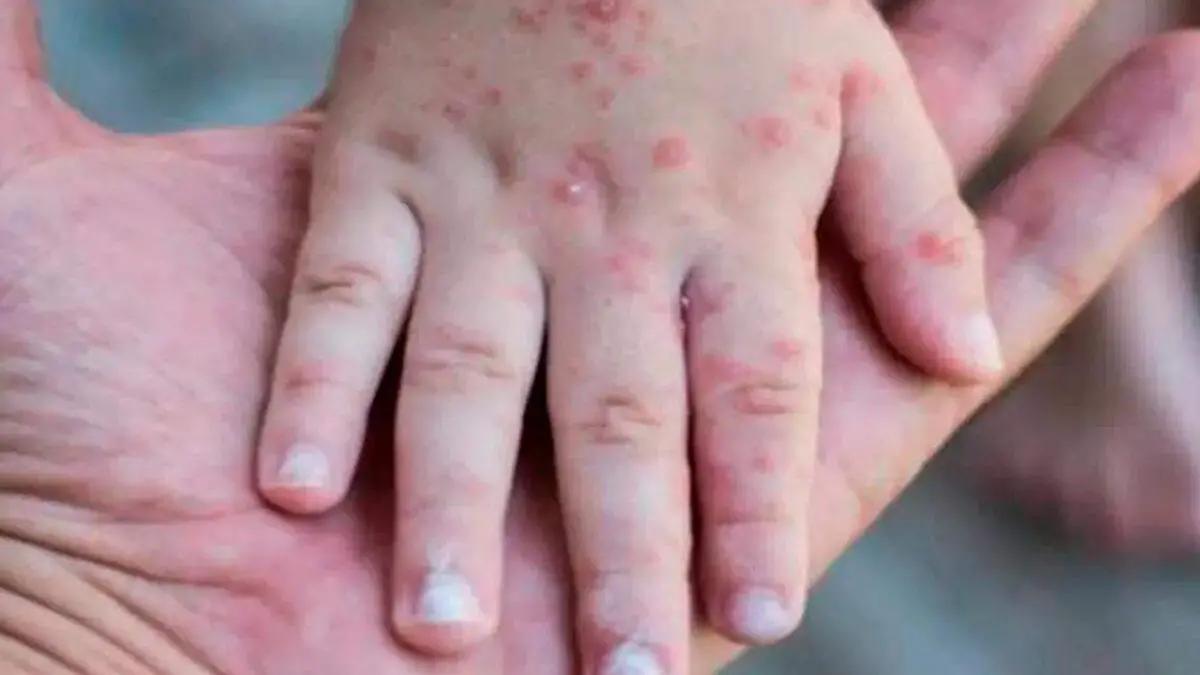 Virus Coxsackie: ¿Sabes cómo se propaga esta enfermedad? Esto es lo que sabemos