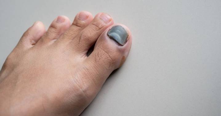 Seven weird reactions you get to exercise - from bleeding to black nails