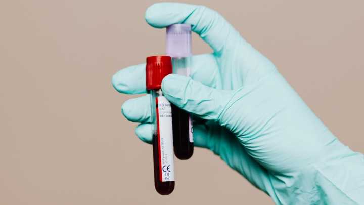 New Chronic Fatigue Syndrome 'Blood Test' Raises Hope And Skepticism