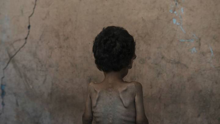 More than 54,600 children younger than 5 may be acutely malnourished in Gaza, study finds