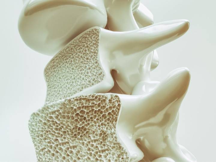Cada minuto ocurren 70 fracturas por osteoporosis en el mundo