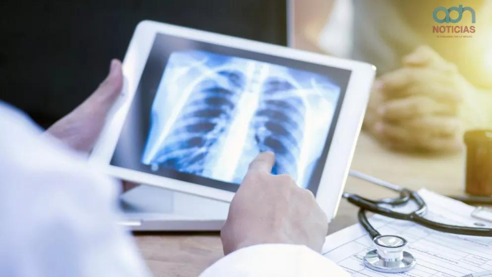 ¡Alerta por tuberculosis! Este es el estado que concentra el 50% de los contagios