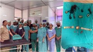 Doctors Of Jaipur's SMS Hospital Remove Watch, Iron Nails From Patient's Abdomen