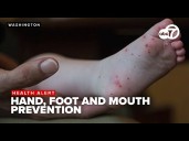 Hand, foot and mouth disease: Managing and prevention