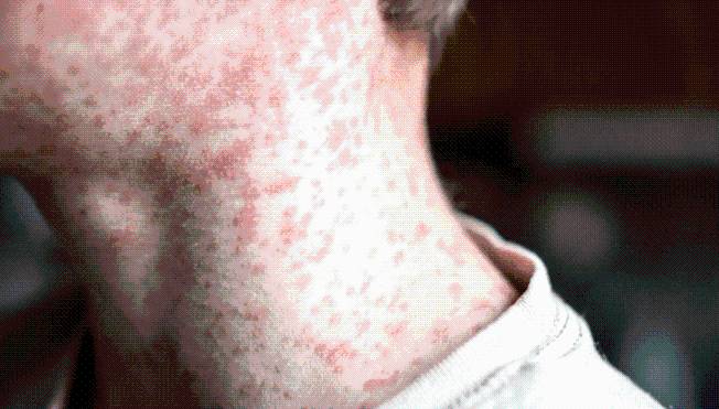 Measles outbreak in South Carolina grows: health officials still searching for source