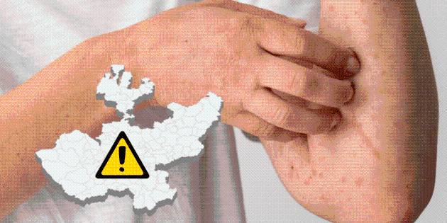 Secretaría de Salud Jalisco confirma nuevo caso de sarampión en preparatoria privada de Zapopan