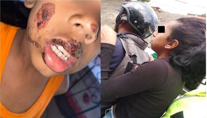 ¡Horror en Caracas! Madre inflige quemaduras en el rostro de su hijo con una cuchara ardiente.