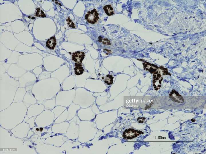 Experts Urge Rethinking Restrictions on Menopausal MHT After Breast Cancer