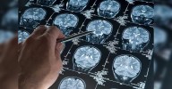 Study finds very few neurosurgeons, neurologists, critical care specialists trained during MBBS on certifying brain death