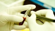 Jharkhand news: 5 kids suffering from thalassemia test HIV
