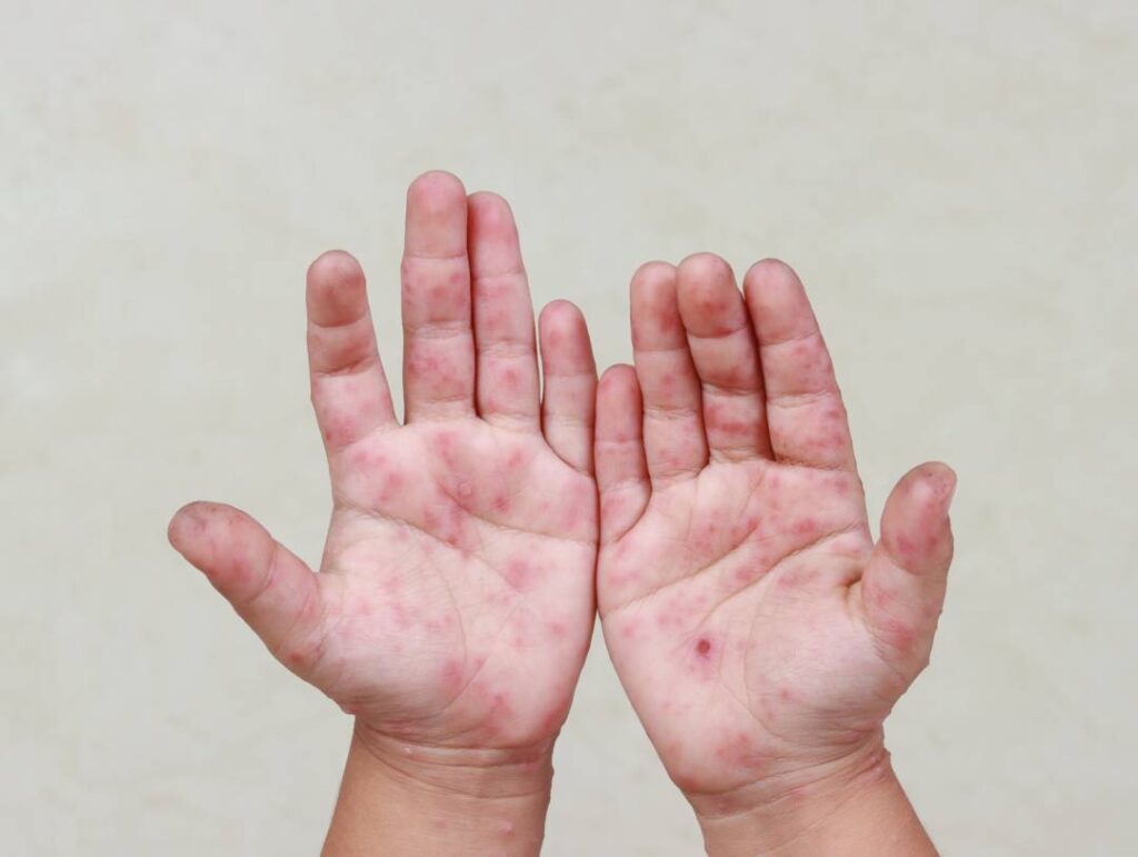 Confirman brote de virus Coxsackie en escuelas de Tlaxcala