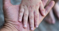 Detectan brote de virus Coxsackie en escuelas de Puebla; autoridades suspenden clases