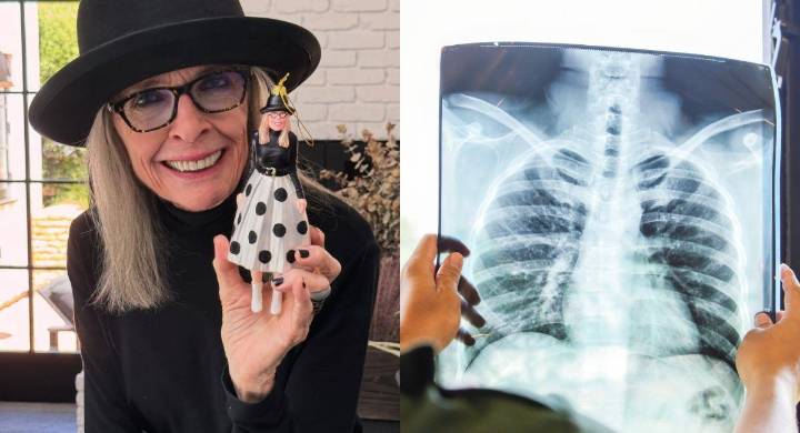 Neumonía: familia de Diane Keaton revela la verdadera causa de su fallecimiento, ¿qué tan peligrosa es?