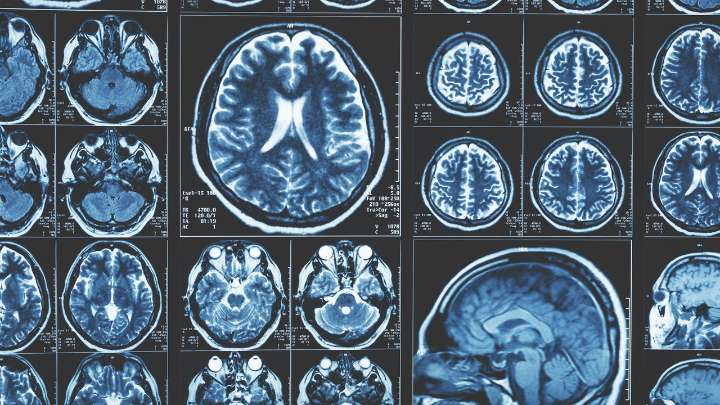 Identifican una enzima clave en la Atrofia Muscular Espinal, enfermedad rara hereditaria