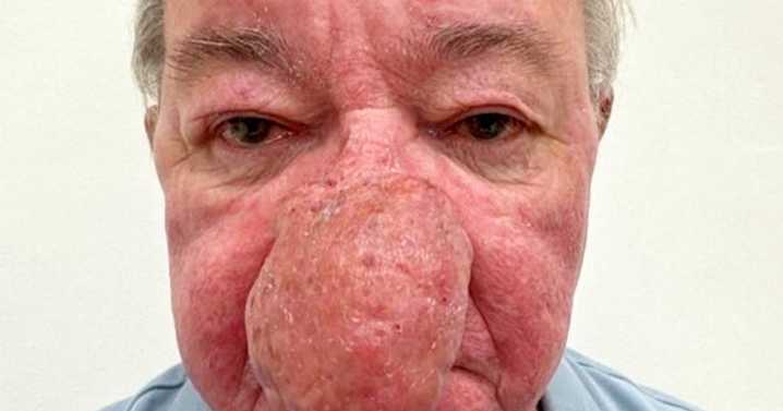 Man undergoes life-changing surgery for massive nose growth