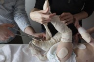La terapia génica para Piel de Mariposa aún no está disponible en España