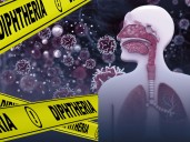 Difteria: Síntomas, Complicaciones y Tratamiento