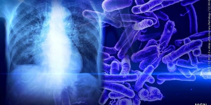 Testing available after 2 diagnosed with tuberculosis in New Hampshire