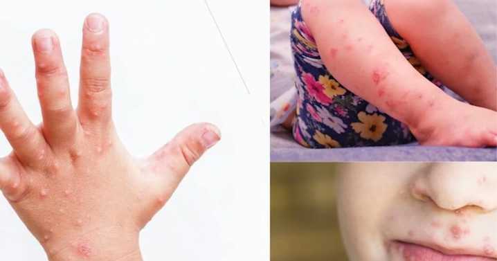 Nearly 200 students, staff affected by outbreak of hand, foot, and mouth disease