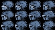 ¿Qué es aneurisma cerebral? Enfermedad que padece Kim Kardashian 