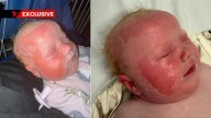 Warning over reflective UV after baby suffers second