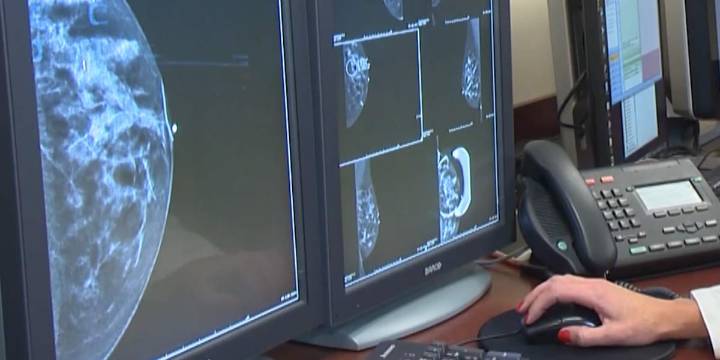 UW School of Medicine joins study of AI use in breast cancer screening