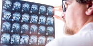 Herramienta de IA es capaz de detectar pequeñas malformaciones cerebrales difíciles de identificar en niños con epilepsia