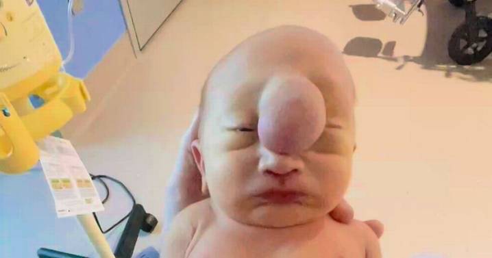 'True miracle' baby born with huge 'bubble' on forehead defies odds