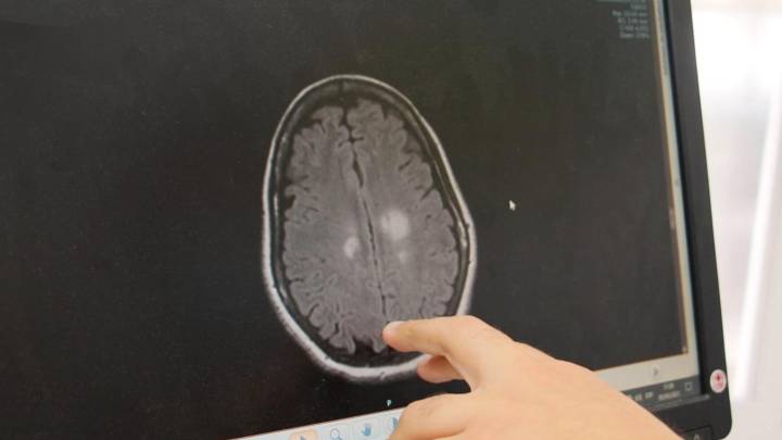 Cataluña registró cerca de 14.000 ingresos por ictus en 2024, una tendencia al alza