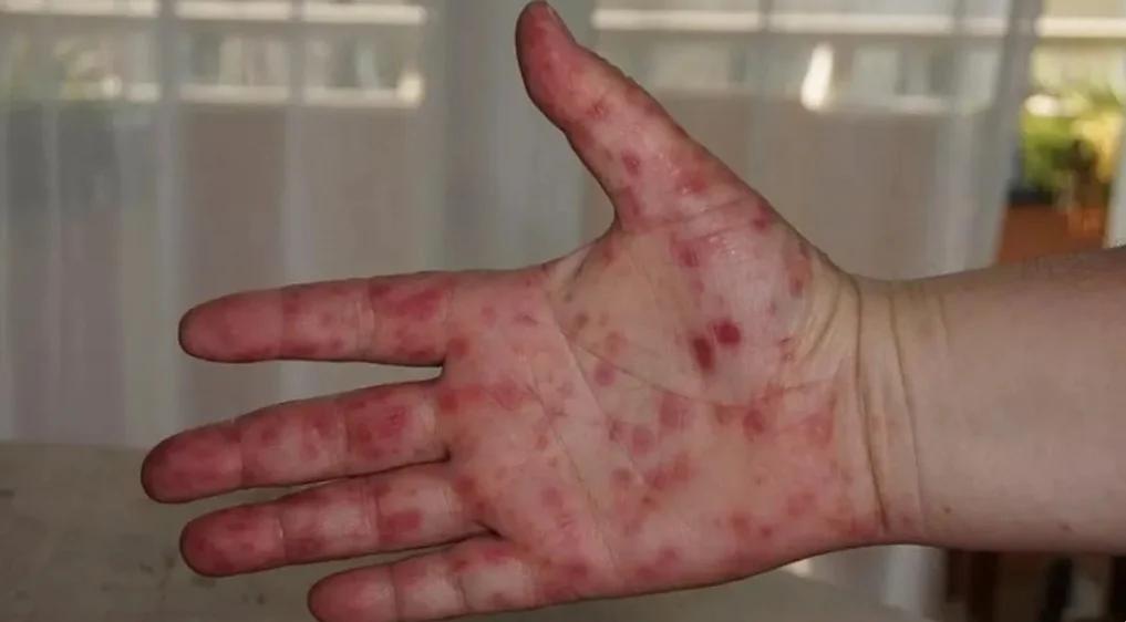Suspenden clases por virus Coxsackie: ¿cuáles son los síntomas y qué tan peligroso es?