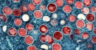 Mpox strain that may be more severe appears to spread locally in U.S. for first time