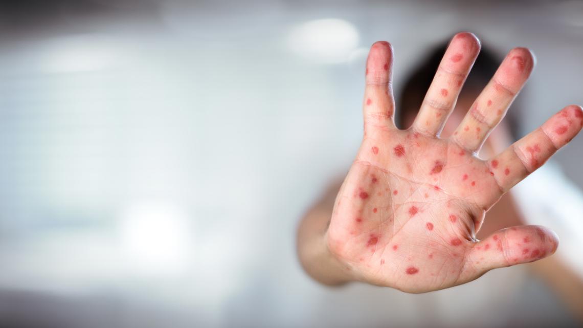 South Carolina reports 11th measles case, warns of community spread in Upstate
