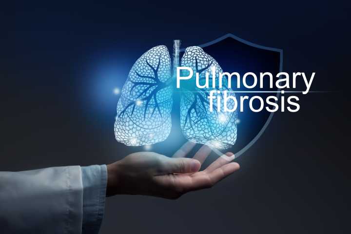 FDA Approves a New Option for Idiopathic Pulmonary Fibrosis