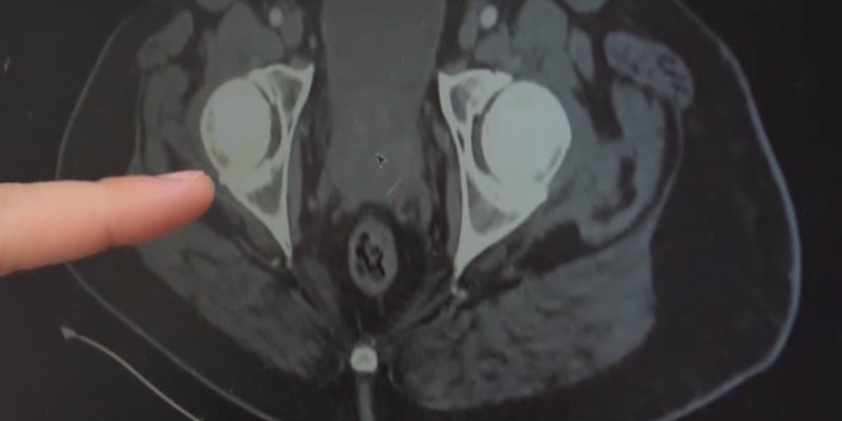 MU Health Care new laser surgery corrects enlarged prostates