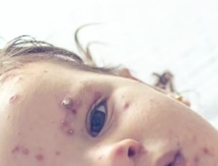 Measles-free status in jeopardy in the Americas as outbreaks continue