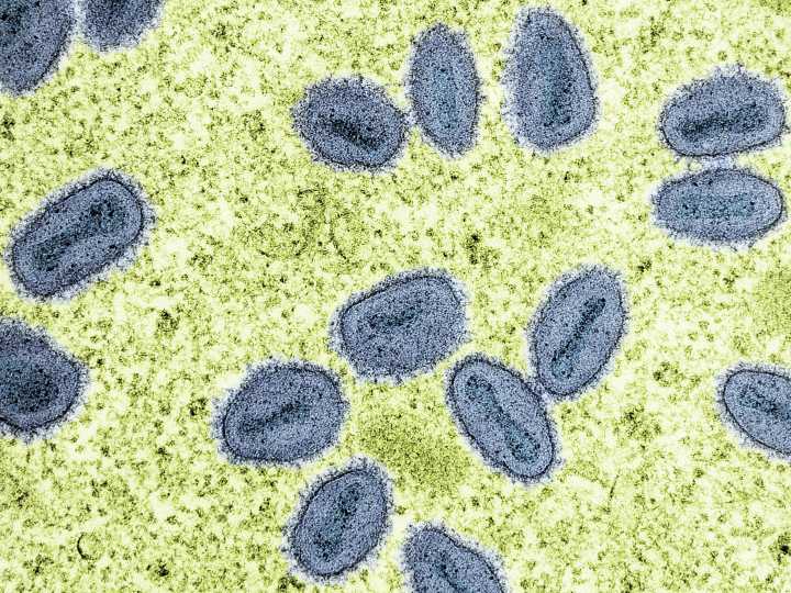 California confirms 1st US case of severe mpox strain with no travel history
